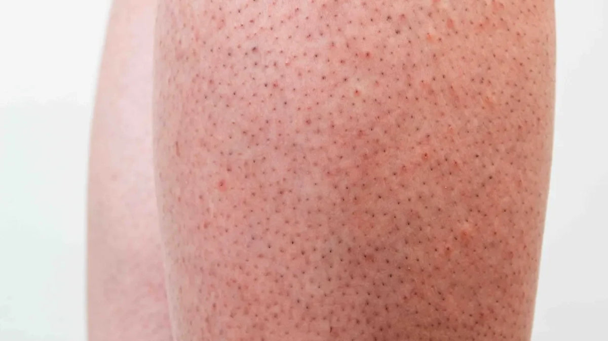 Strawberry legs_blog