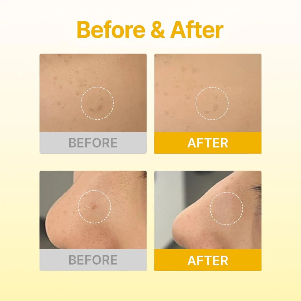 Dark Spot Care Microcone Patch