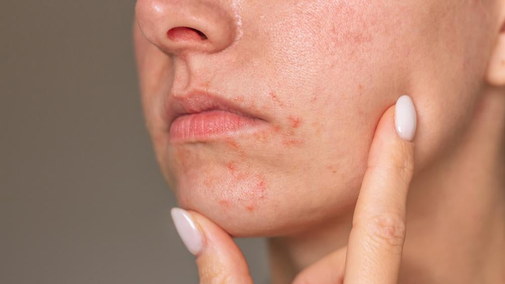 Perioral Dermatitis